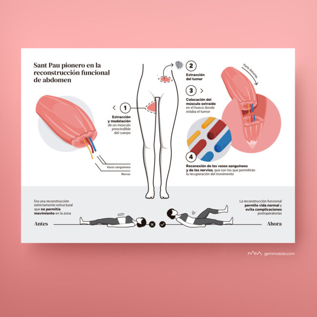 Infografia operació abdomen hospital Sant Pau. Il·lustracions de Gemma Solà